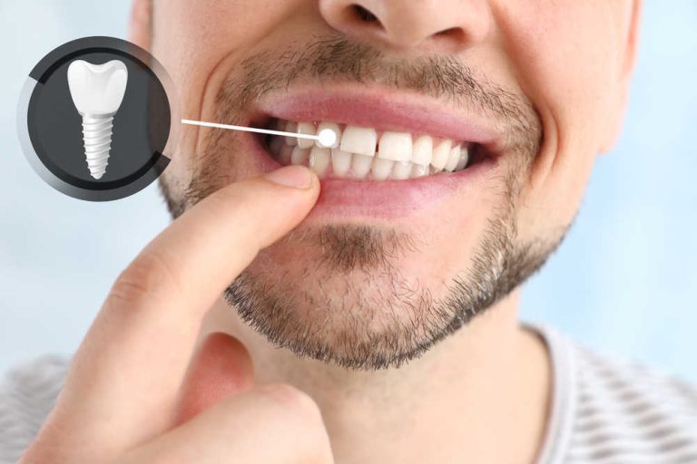 8 consejos para mantener los implantes dentales